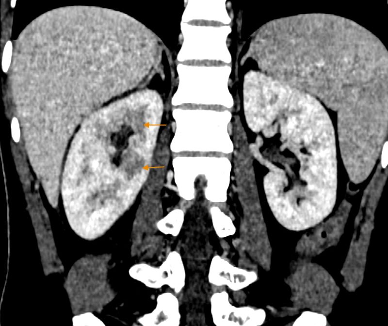 Hình ảnh CT của bệnh nhân cho thấy nhu mô thận ngấm thuốc không đều, biểu hiện của viêm thận - Ảnh: BVCC