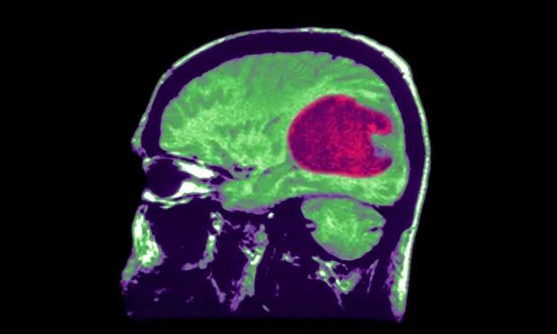 Ảnh chụp X-quang cho thấy khối u thần kinh đệm - khối u não phổ biến nhất ở bệnh nhân ung thư. Ảnh: Getty Images