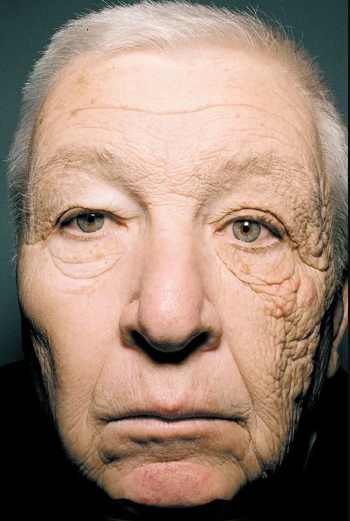 Khuôn mặt của một tài xế xe tải minh chứng rõ rệt cho tác hại của tia UV đối với làn da