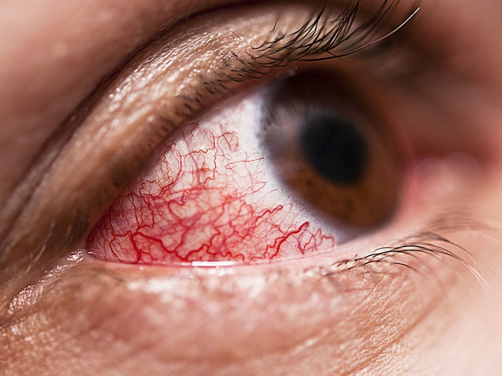 Tổn thương mạch máu nhỏ ở võng mạc có thể dẫn tới biến chứng mắt đái tháo đường