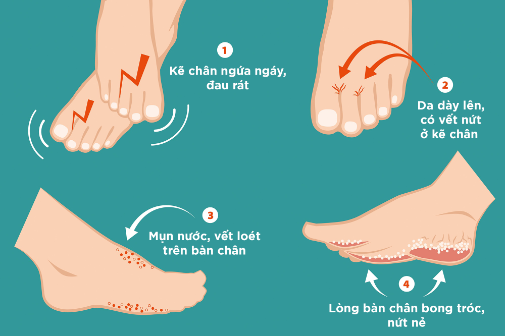 Nấm da chân (nước ăn chân) gây ra tổn thương ở cả kẽ ngón chân lẫn lòng bàn chân