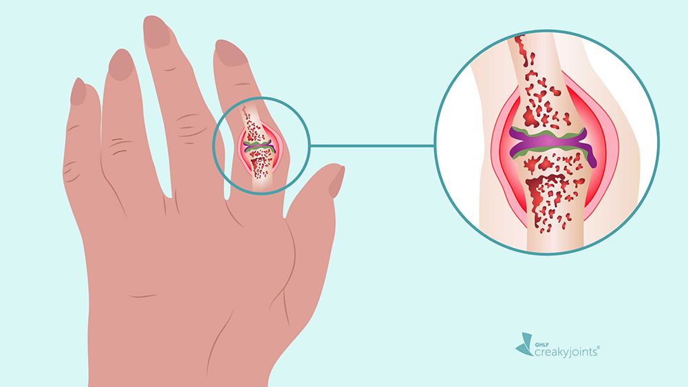 Các tổn thương ăn mòn phần mềm xung quanh khớp bàn ngón sẽ gây ra tình trạng trật khớp