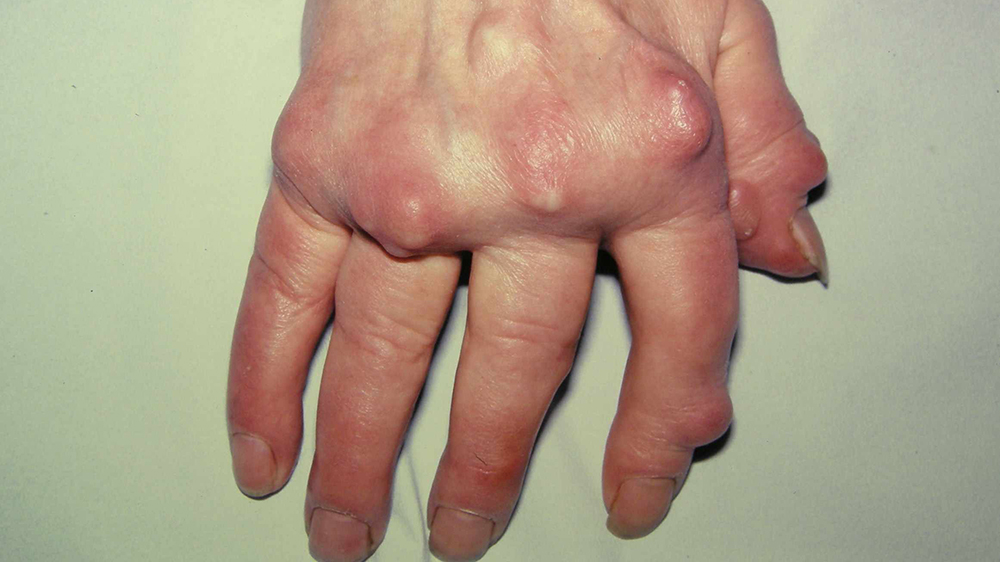 Bàn tay nổi cục tophi ở bệnh nhân gout