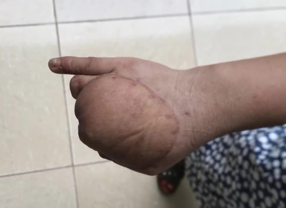 Bàn tay bệnh nhân sau khi phẫu thuật chuyển vạt - Ảnh: sức khỏe & Đời sống