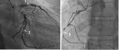 Hình ảnh chụp động mạch vành cho thấy bệnh nhân bị hẹp 99% các động mạch liên thất trước (1), động mạch mũ (2) và động mạch vành phải (3) - Ảnh: Bệnh viện Đại học Y Hà Nội