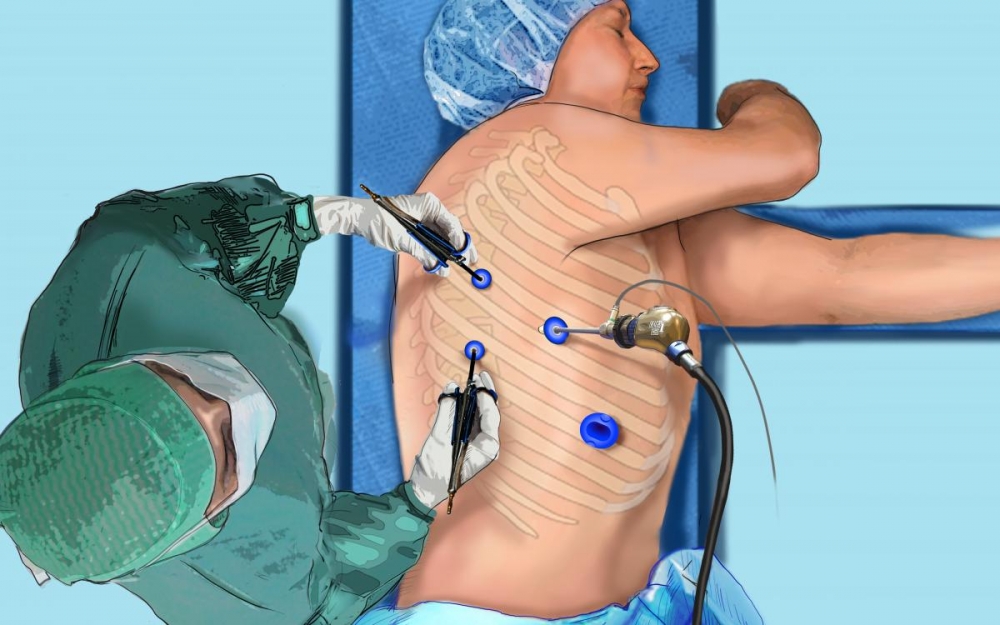 Phẫu thuật nội soi lồng ngực cắt thùy phổi trong điều trị ung thư phổi 