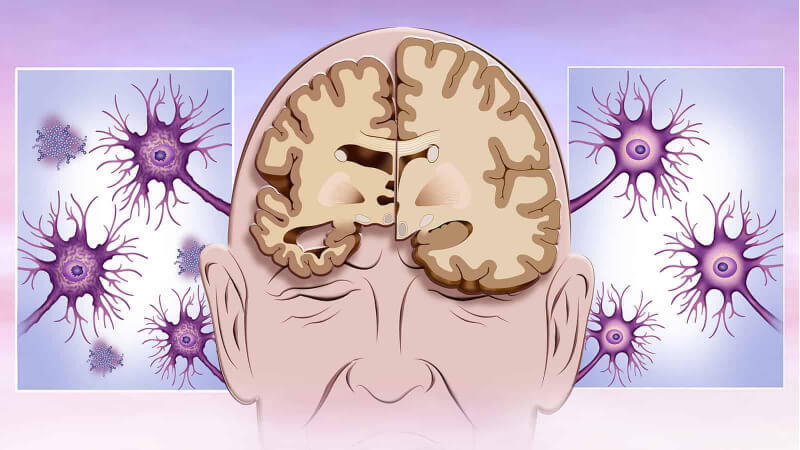 Bệnh nha chu liên quan tới tình trạng sự gia tăng protein tau trong não người bệnh Alzheimer