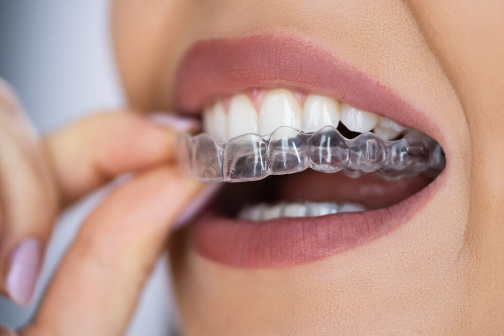 Chỉ sử dụng khay, máng niềng răng sau khi được thăm khám, tư vấn điều trị bởi bác sĩ chỉnh nha