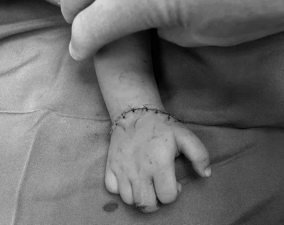 Bàn tay bị đứt rời của bệnh nhi đã được nối thành công sau hơn 5 giờ phẫu thuật. Ảnh: BVCC