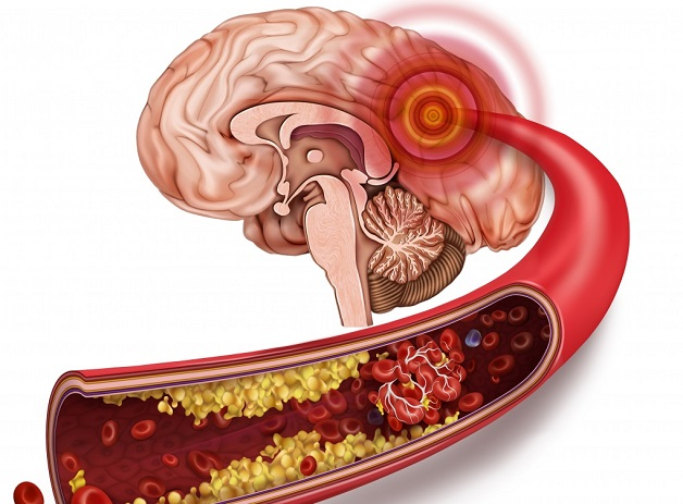 Mỡ máu cao - nguyên nhân hàng đầu gây tai biến mạch máu não
