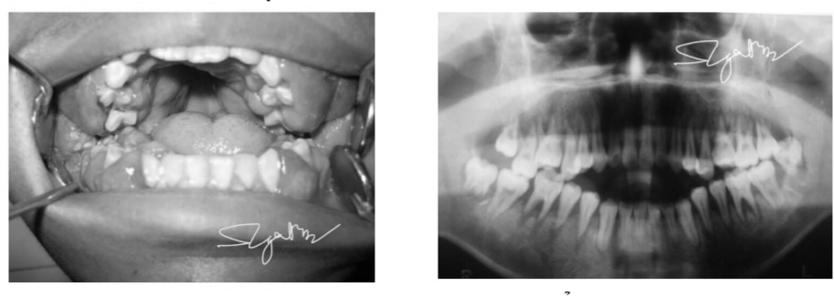 Hình ảnh thương tổn hai lợi của bệnh nhân và hình ảnh chụp X-quang. Ảnh: BVCC