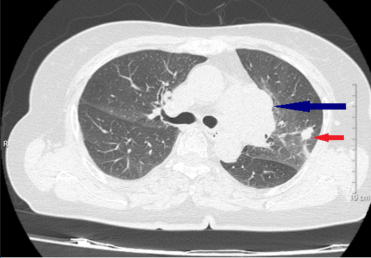 Hình ảnh cắt lớp vi tính lồng ngực của bệnh nhân lúc mới chẩn đoán (mũi tên xanh: khối ở trung thất giữa; mũi tên đỏ: nốt đặc ở phổi cùng bên) - Ảnh: BVCC