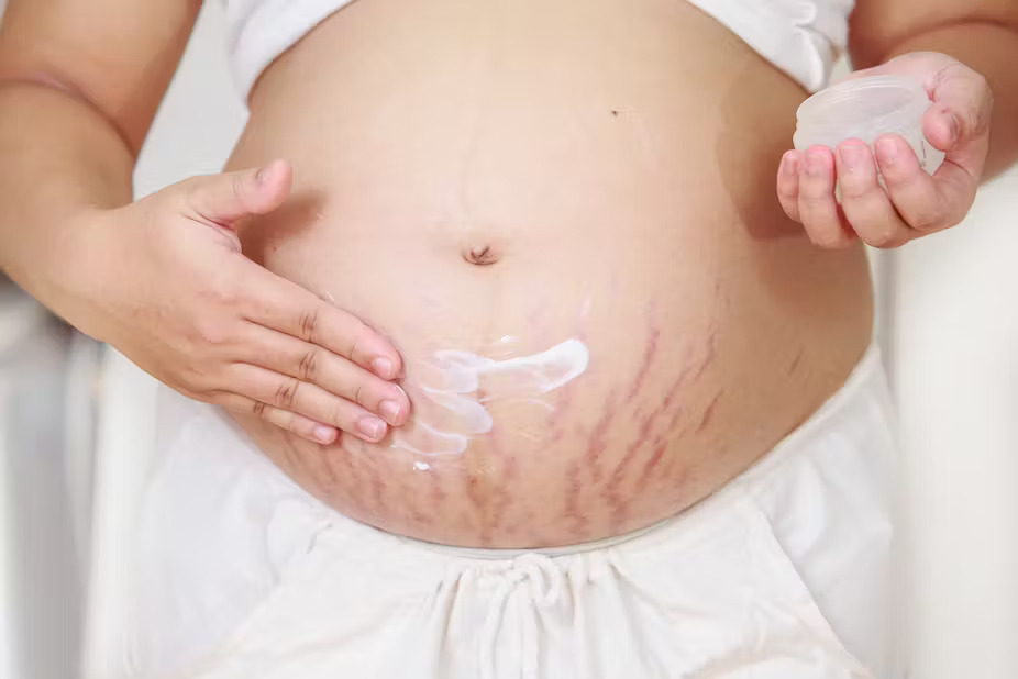 Rạn da đỏ thường gặp ở phụ nữ mang thai khi kích thước bụng tăng nhanh