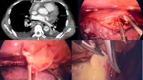 Hình ảnh dị vật cản quang xương cá trên phim cắt lớp và trong phẫu thuật của bệnh nhân thứ 3 - Ảnh: Bệnh viện Bạch Mai.