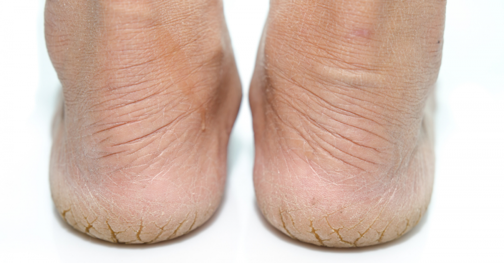 Hiện tượng khô và nứt vùng da gót chân gây khó khăn, đau nhức