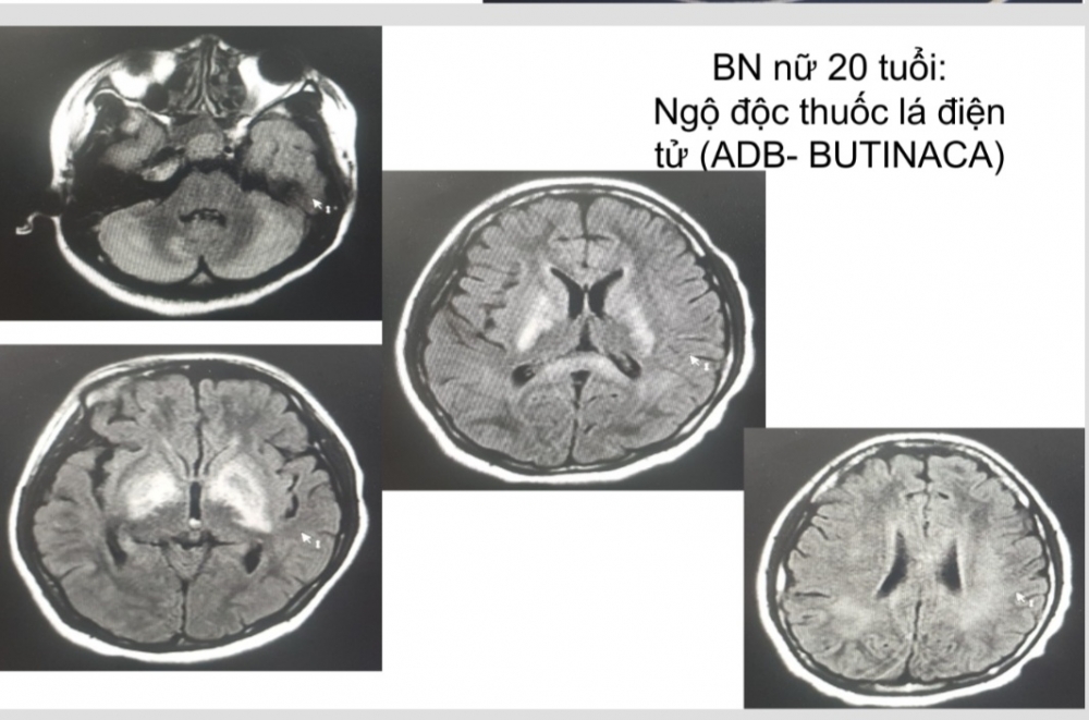 Hình ảnh não bệnh nhân bị tổn thương nặng do thuốc lá điện tử - Ảnh: BVCC