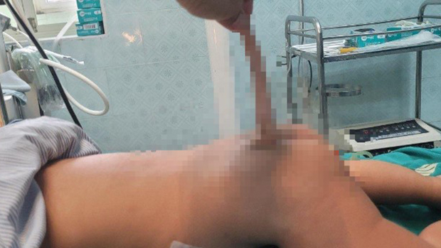 Hình ảnh đuôi dị tật trước khi phẫu thuật - Ảnh: Bệnh viện Nhi Thanh Hóa