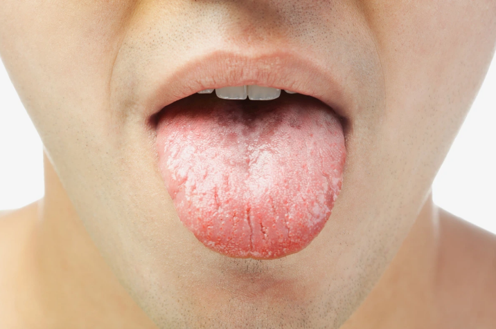 Thiếu kẽm là một trong những yếu tố khiến lưỡi bị nứt
