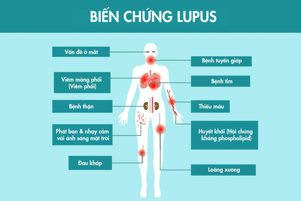Những biến chứng của bệnh Lupus ban đỏ.