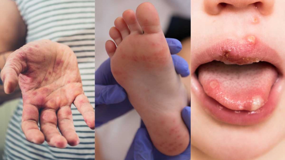 Triệu chứng điển hình ở bệnh tay chân miệng là phát ban dạng phỏng nước ở lòng bàn tay, bàn chân, miệng