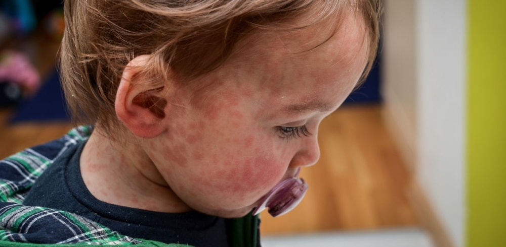Triệu chứng điển hình khi trẻ mắc bệnh sởi là sốt kèm nổi phát ban khắp cơ thể - Ảnh: Getty Iamges