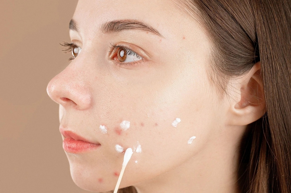 Kẽm bôi ngoài da có thể giúp giảm viêm do mụn, thúc đẩy làn da nhanh lành