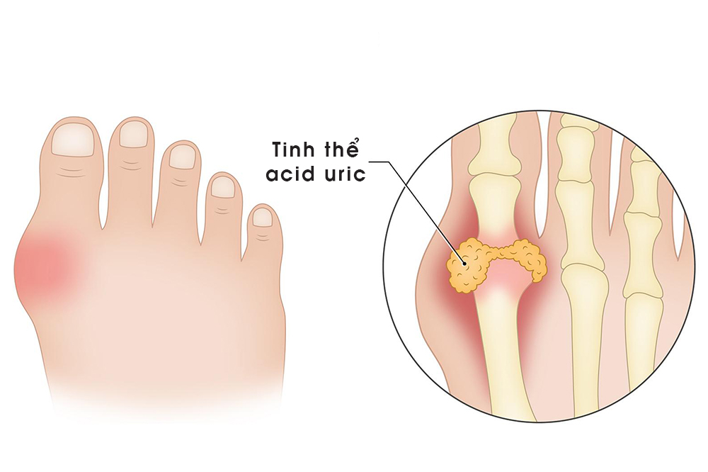 Các tinh thể acid uric tích tụ tại khớp ngón chân cái, gây ra cơn gout cấp khiến ngón chân đau nhức