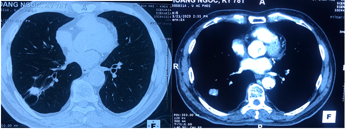 Hình ảnh cắt lớp vi tính ngực tháng 3/2023 (sau 7 năm điều trị): hình ảnh tổn thương thùy dưới phổi phải kích thước 19x17mm, trong có vôi hóa, giãn phế quản, phế nang và dày kẽ xung quanh - Ảnh: BVCC