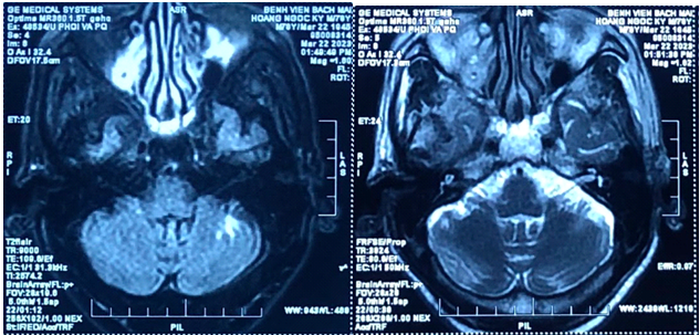 Hình ảnh vùng tổn thương không ngấm thuốc bán cầu tiểu não trái, không phù não xung quanh (ổn định so với các phim chụp cũ) tương ứng với tổn thương sau điều trị - Ảnh: BVCC