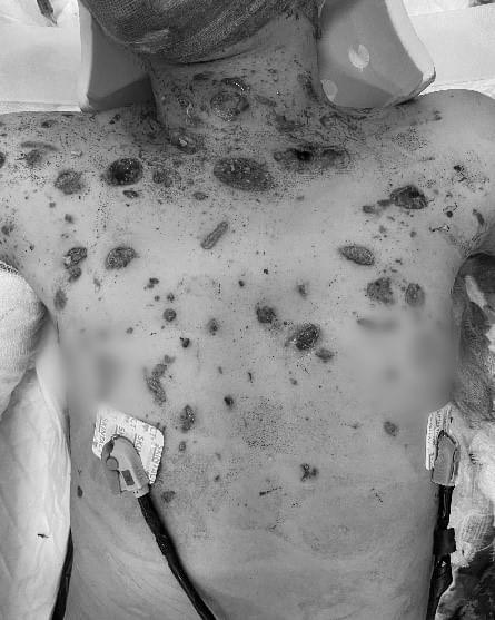 Nam sinh 13 tuổi bị đa chấn thương do các mảnh vỡ của laptop phát nổ găm vào người - Ảnh: BVCC