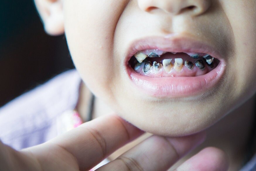 Răng sữa bị sâu sẽ rụng sớm, ảnh hưởng đến cấu trúc hàm răng của trẻ