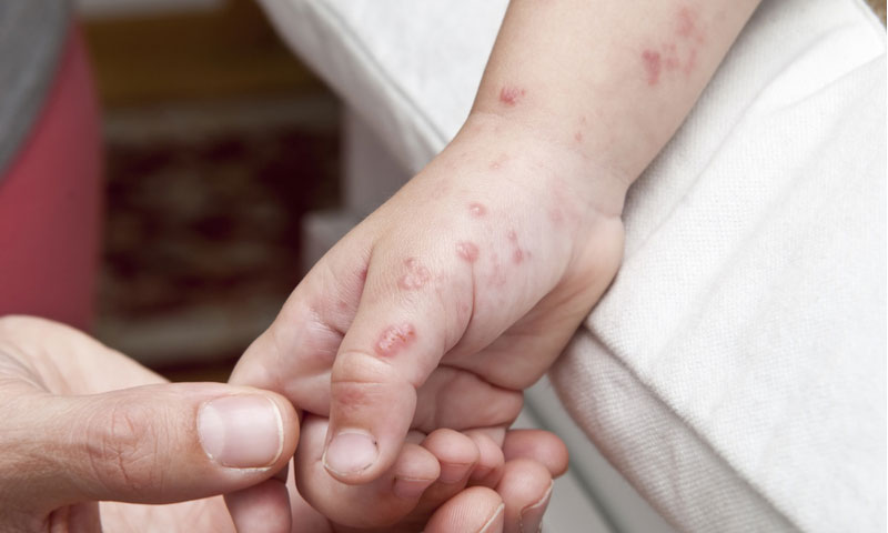 Thủy đậu là bệnh rất dễ lây lan qua đường tiếp xúc trực tiếp hoặc do virus từ dịch tiết của trẻ mắc bệnh