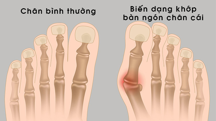 Người mang giày dép không phù hợp hoặc do viêm khớp dạng thấp có nguy cơ biến dạng ngón chân cái