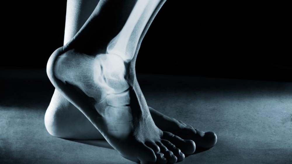 Rạn xương bàn chân ảnh hưởng nhiều đến khả năng vận động ở người cao tuổi