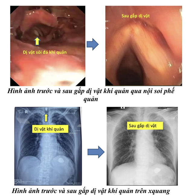  Bệnh viện Phổi Trung ương