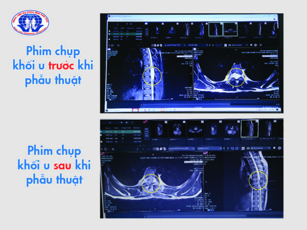 Phim chụp trước và sau phẫu thuật khối u tủy nguyên nhân gây liệt đôi chân - Ảnh: BVĐK tỉnh Phú Thọ.