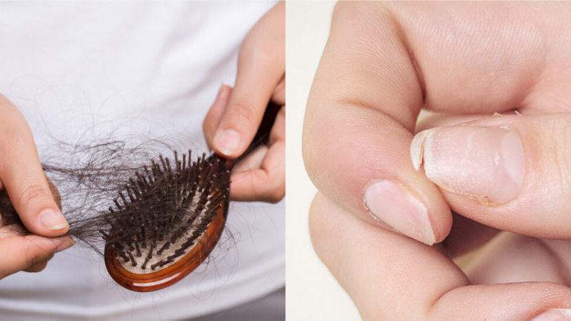 Thiếu hụt biotin có thể dẫn đến rụng tóc và các vấn đề về da, móng tay