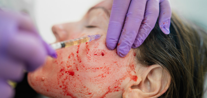 Sau khi PRP được tiêm trở lại dưới da, khuôn mặt của bạn sẽ được phủ một “mặt nạ huyết tương”.