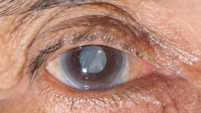 Bệnh glaucoma có nhiều thể bệnh với nguyên nhân khác nhau, nhưng đều khiến hệ thần kinh thị giác bị tổn thương