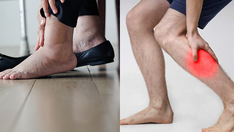 Hiện tượng phù nề ở chân, đau chân có thể là dấu hiệu bệnh tim mạch nguy hiểm