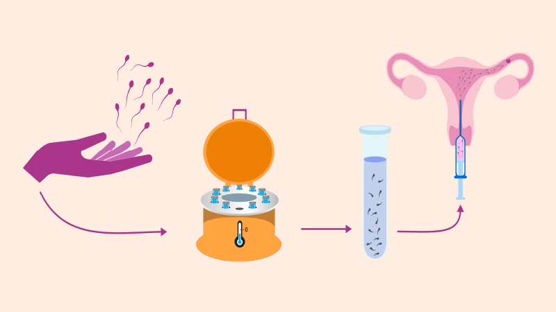 Trong thụ tinh nhân tạo (IUI), tinh trùng sẽ được lọc rửa và bơm trực tiếp vào buồng tử cung ở giai đoạn rụng trứng