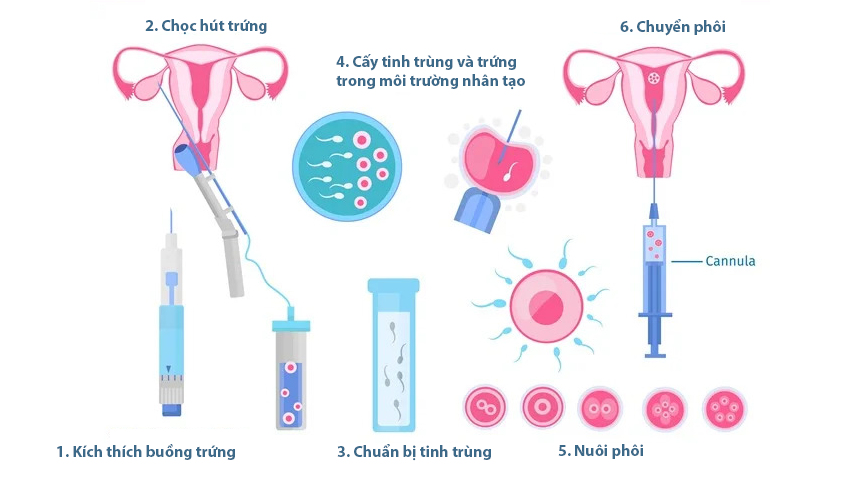 Thụ tinh trong ống nghiệm (IVF) trải qua nhiều bước điều trị hơn