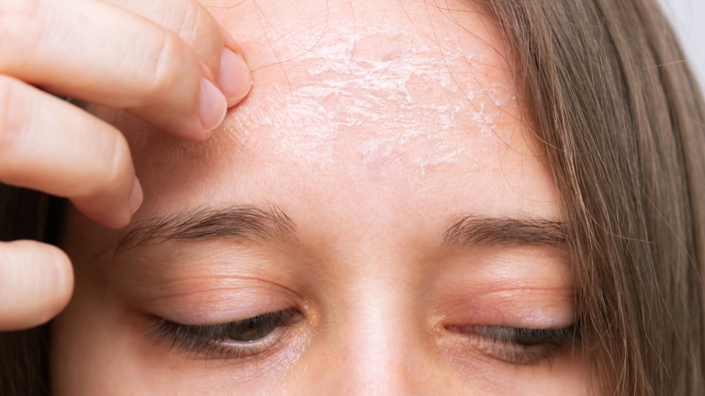 Lạm dụng retinol có thể gây kích ứng, bong da, khiến da dễ tổn thương khi tiếp xúc với ánh nắng