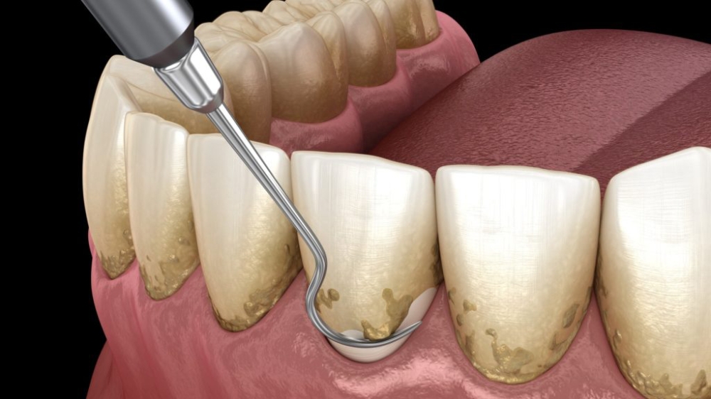 Vệ sinh răng miệng, lấy cao răng là bước rất quan trọng để giải quyết nguyên nhân viêm nha chu