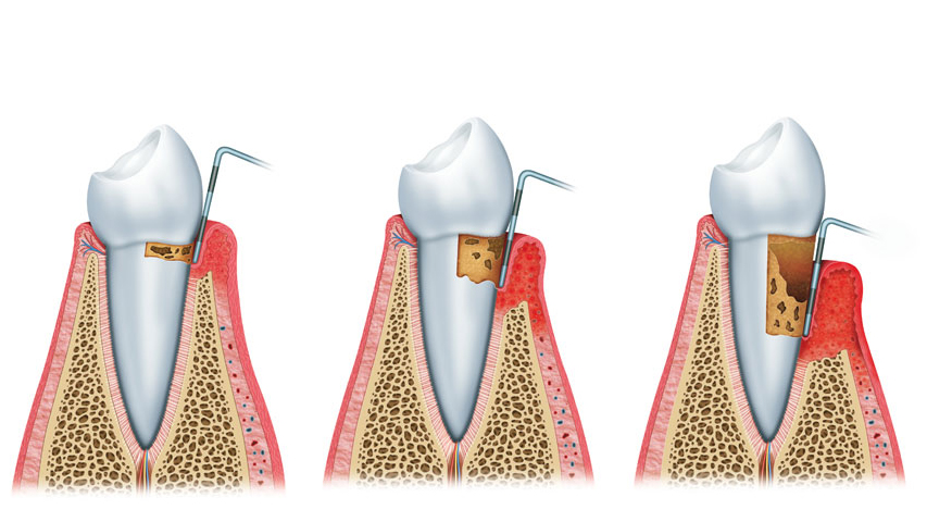 Viêm quanh răng là tình trạng nhiễm trùng nghiêm trọng làm tổn thương mô mềm xung quanh răng