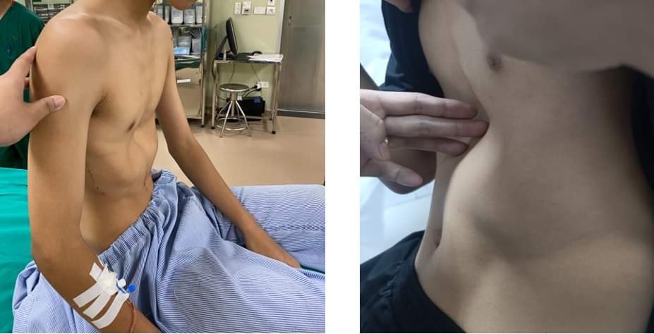 Thiếu niên 15 tuổi bẩm sinh bị lõm ngực thể nặng, thường xuyên đau tức ngực, xương ức lõm sâu - Ảnh: Lao Động Thủ Đô