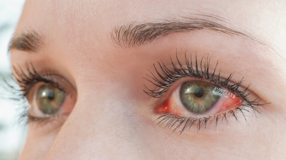 Mắt bị tổn thương do tia UV có dấu hiệu đỏ, chảy nhiều nước mắt, cảm giác cộm mắt