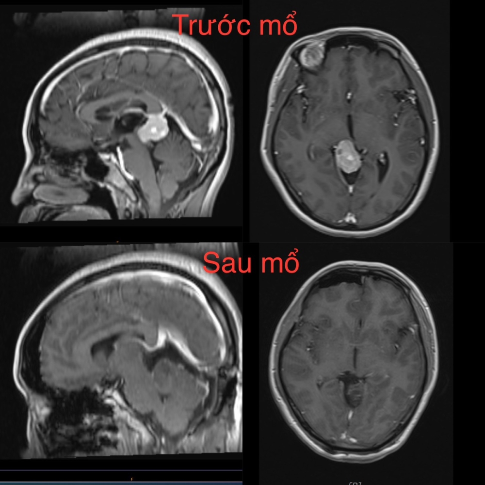 Hình ảnh khối u trước mổ (hàng trên) và sau mổ (hàng dưới) cho thấy khối u đã được loại bỏ hoàn toàn - Ảnh: BV Hữu nghị Việt Đức.