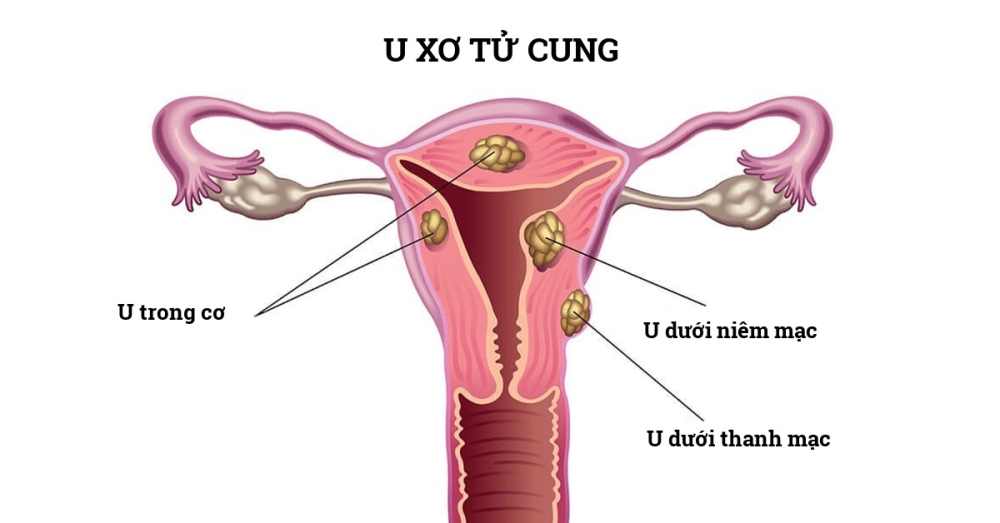 U xơ tử cung được phân loại theo từng vị trí, có ảnh hưởng khác nhau tới khả năng mang thai