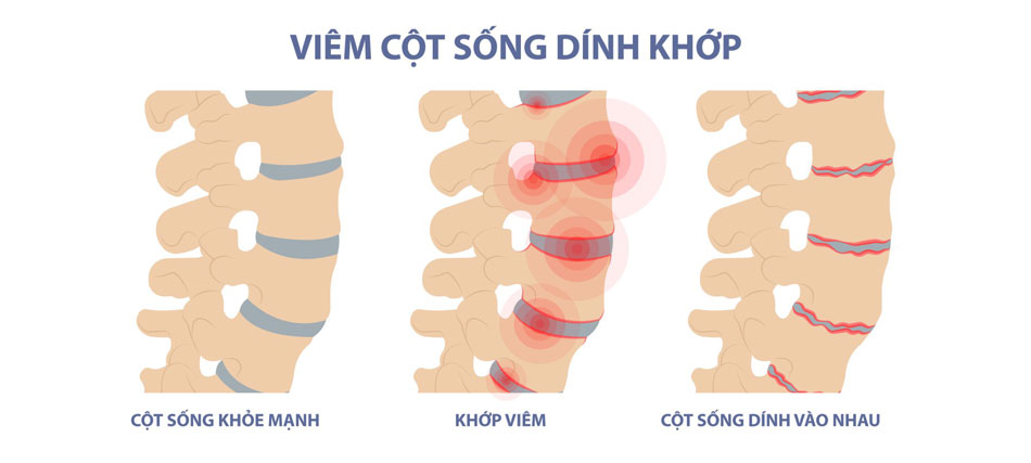 Viêm cột sống dính khớp khiến cột sống mất khả năng di động, biến dạng tư thế